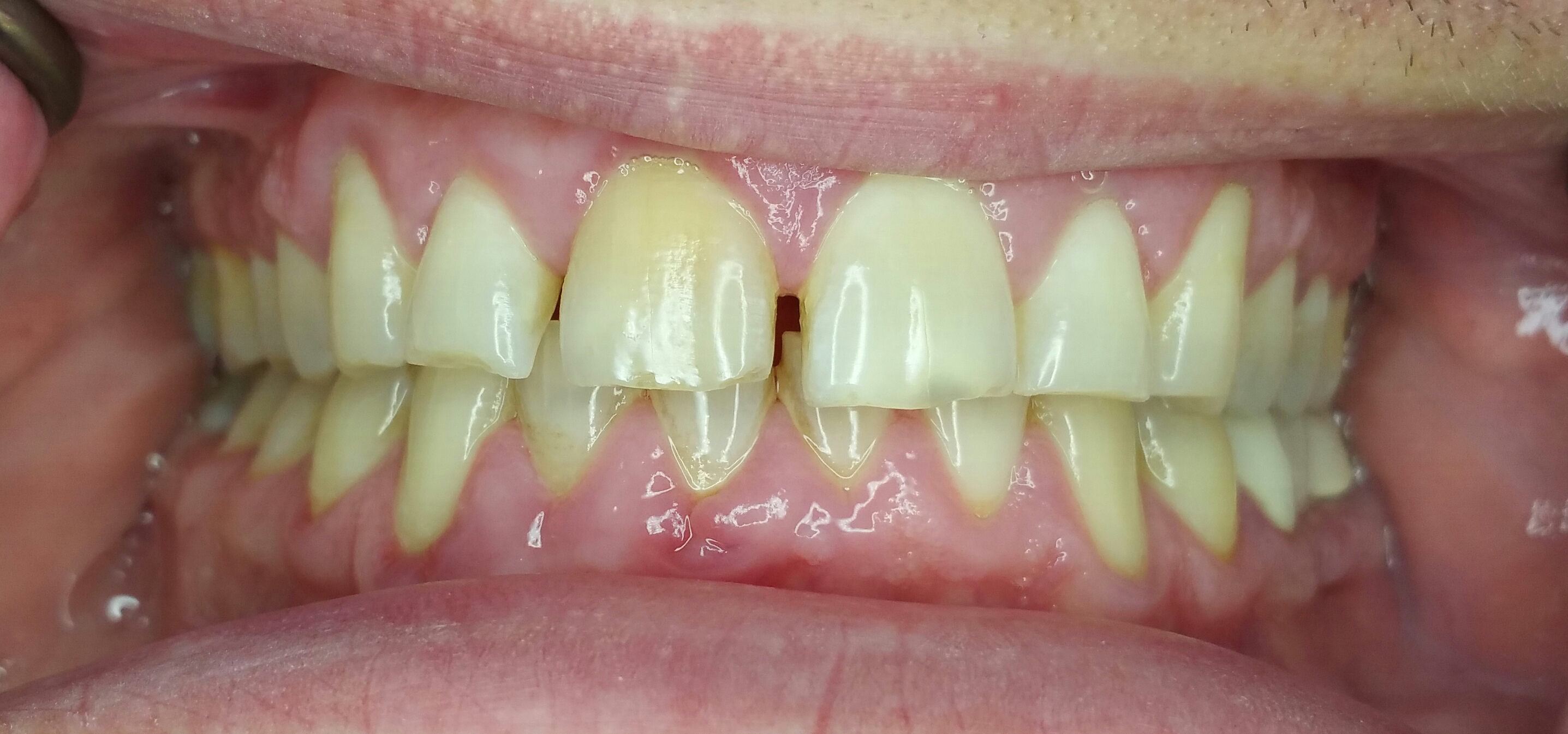 Invisalign Case 1 Before