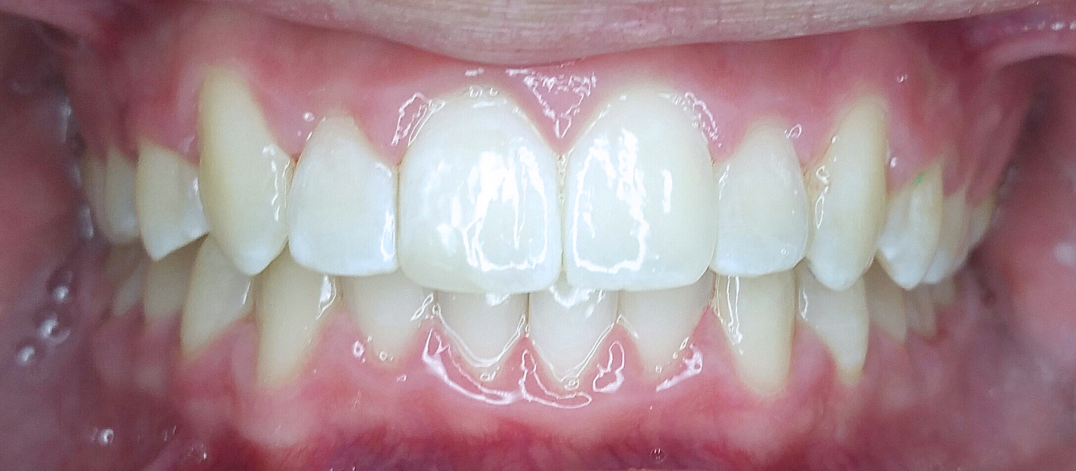 PowerProx 6-month Braces Case 1 after