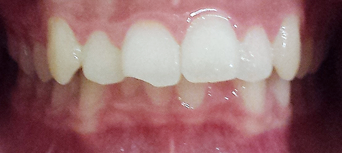 PowerProx 6-month Braces Case 1 Before