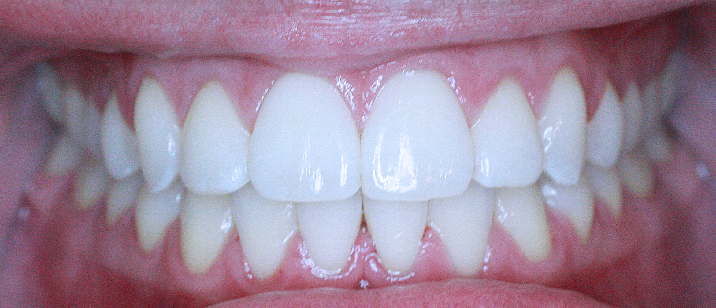 PowerProx 6-month Braces Case 2 after