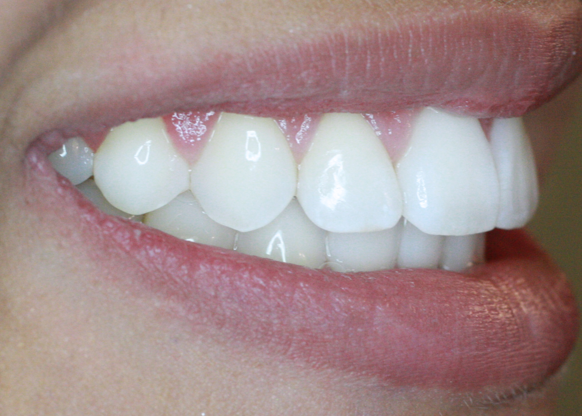 PowerProx 6-month Braces Case 3 after