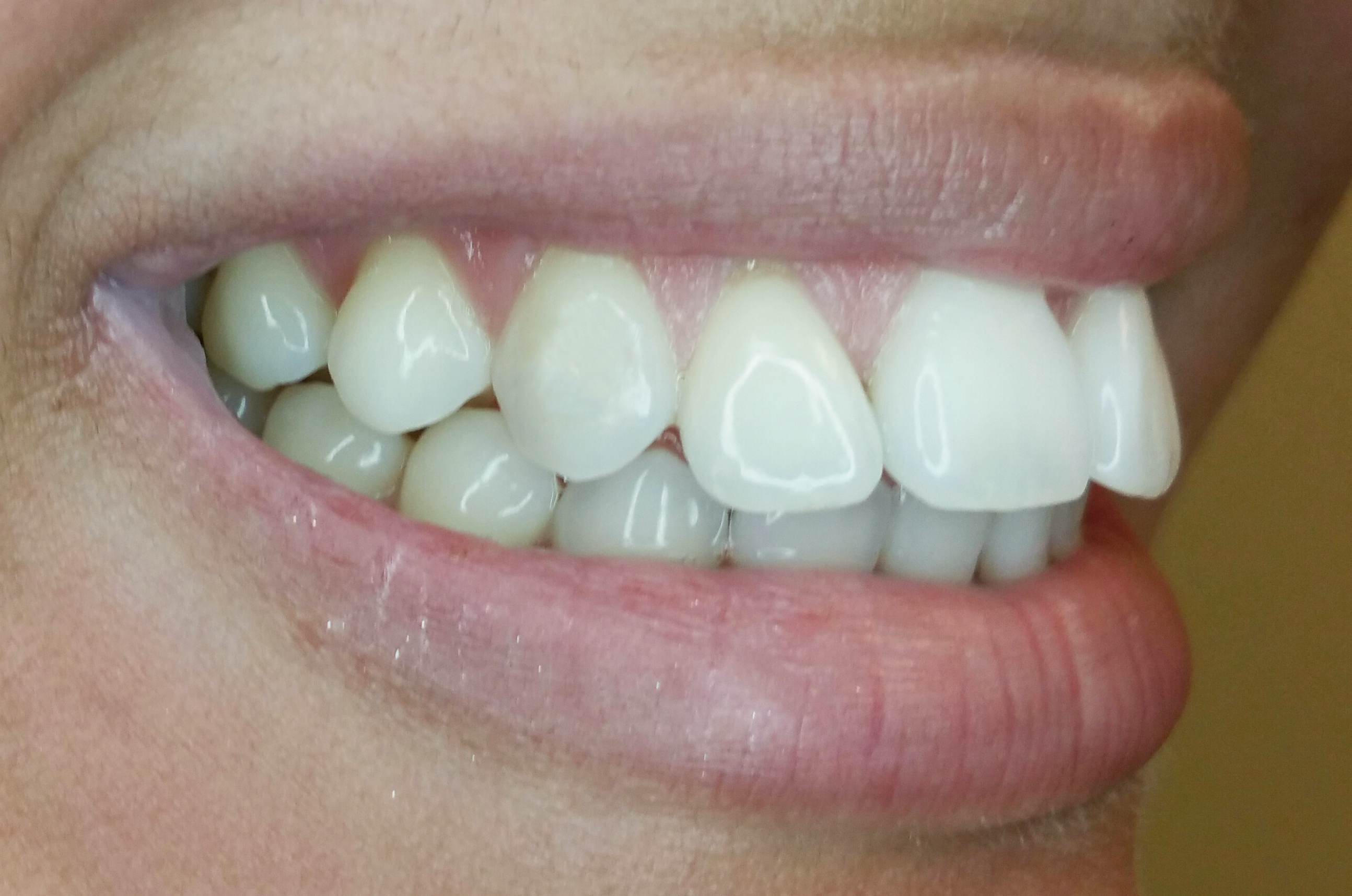 PowerProx 6-month Braces Case 3 Before