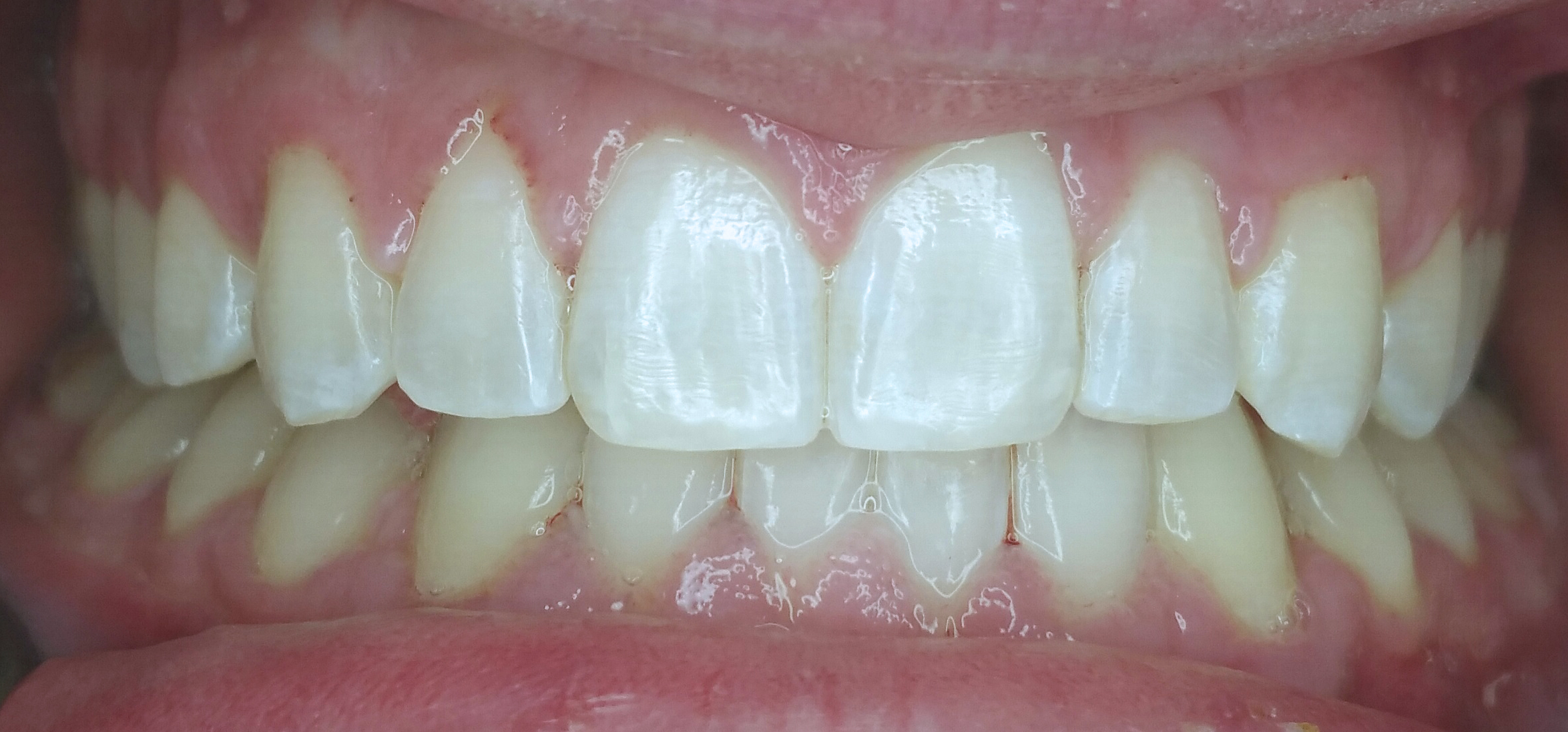 PowerProx 6-month Braces Case 4 after