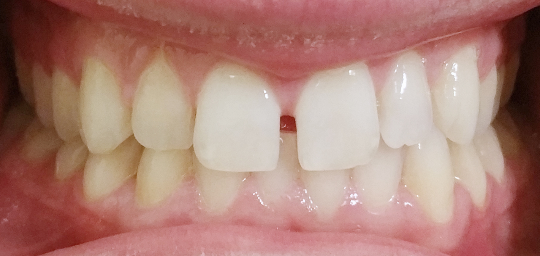 PowerProx 6-month Braces Case 4 Before