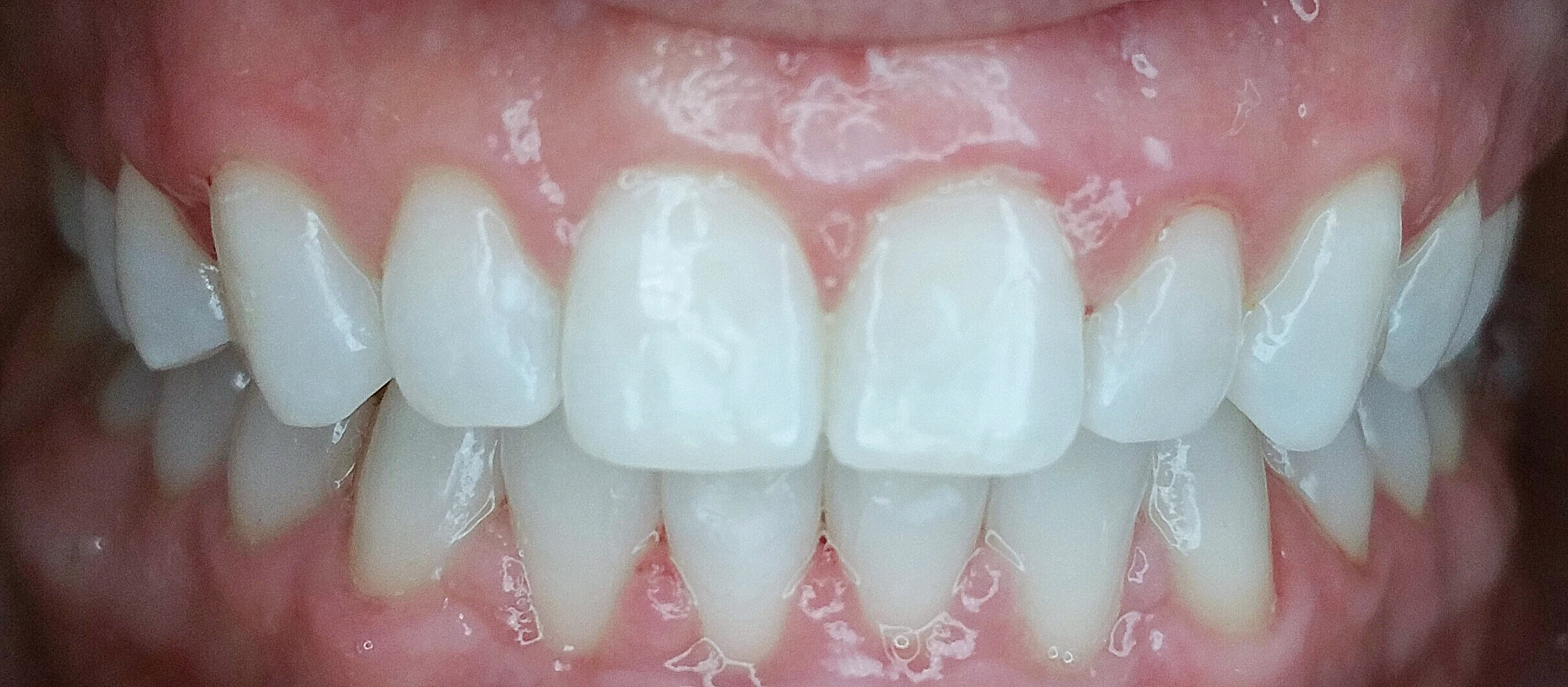 PowerProx 6-month Braces Case 5 after