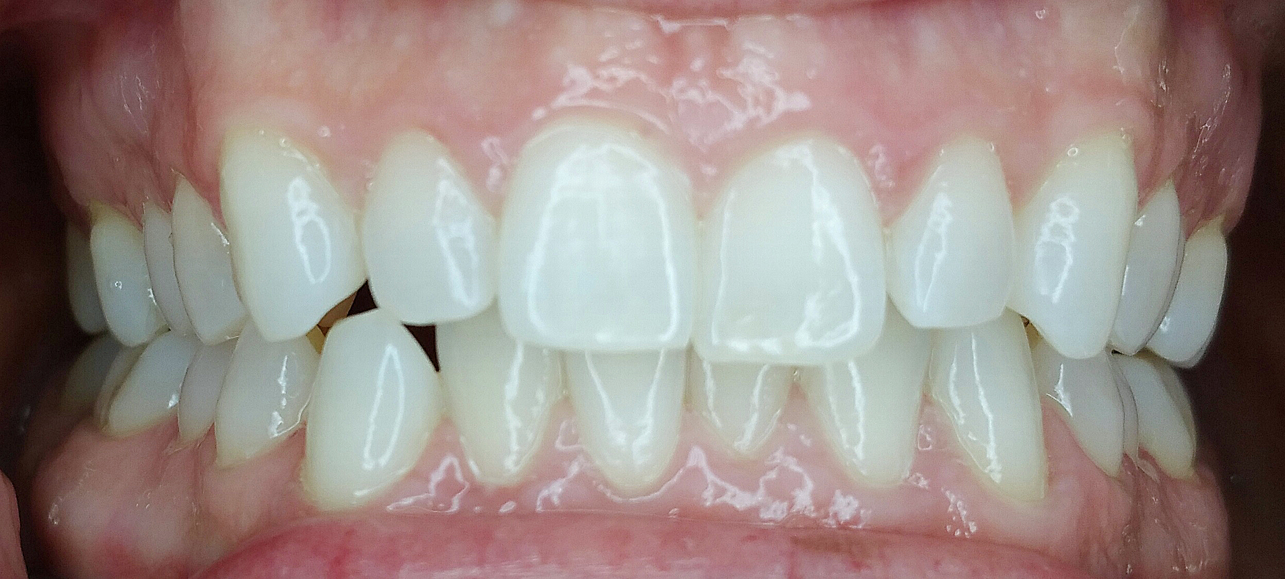 PowerProx 6-month Braces Case 5 Before