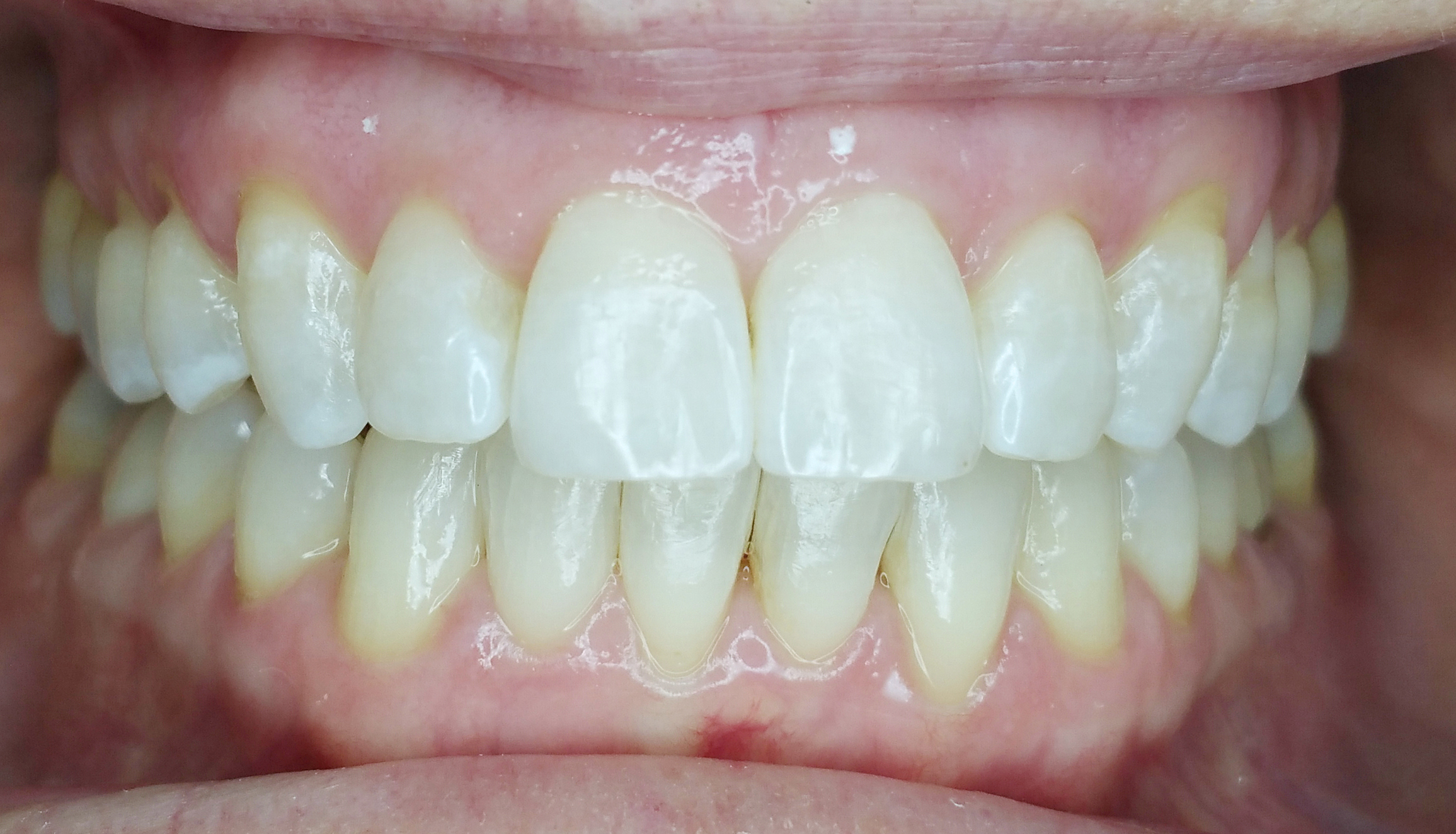 PowerProx 6-month Braces Case 6 after