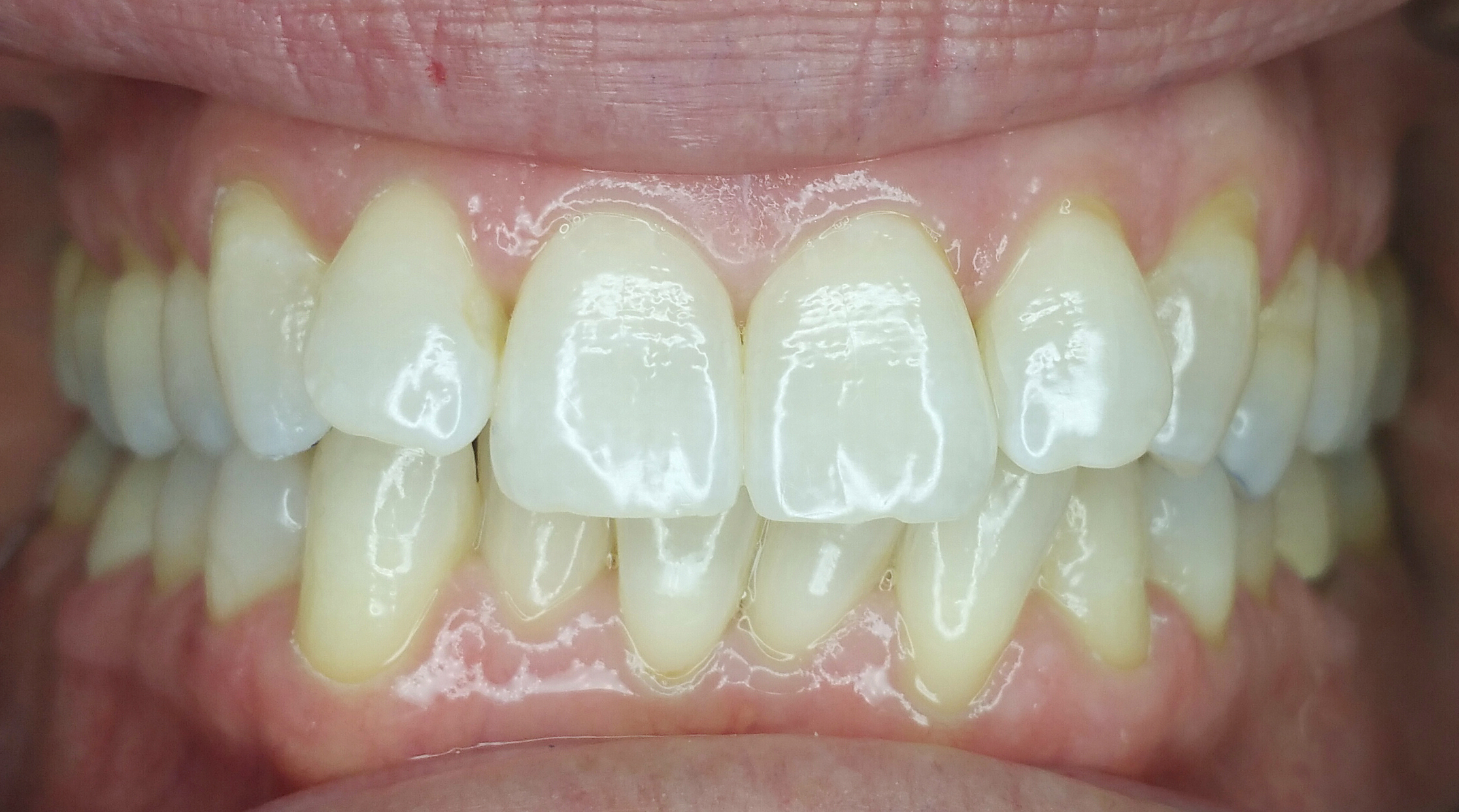 PowerProx 6-month Braces Case 6 Before