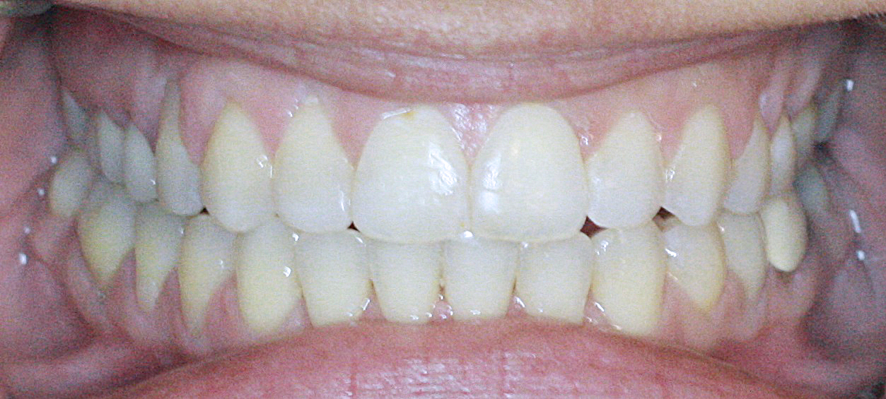 PowerProx 6-month Braces Case 7 after