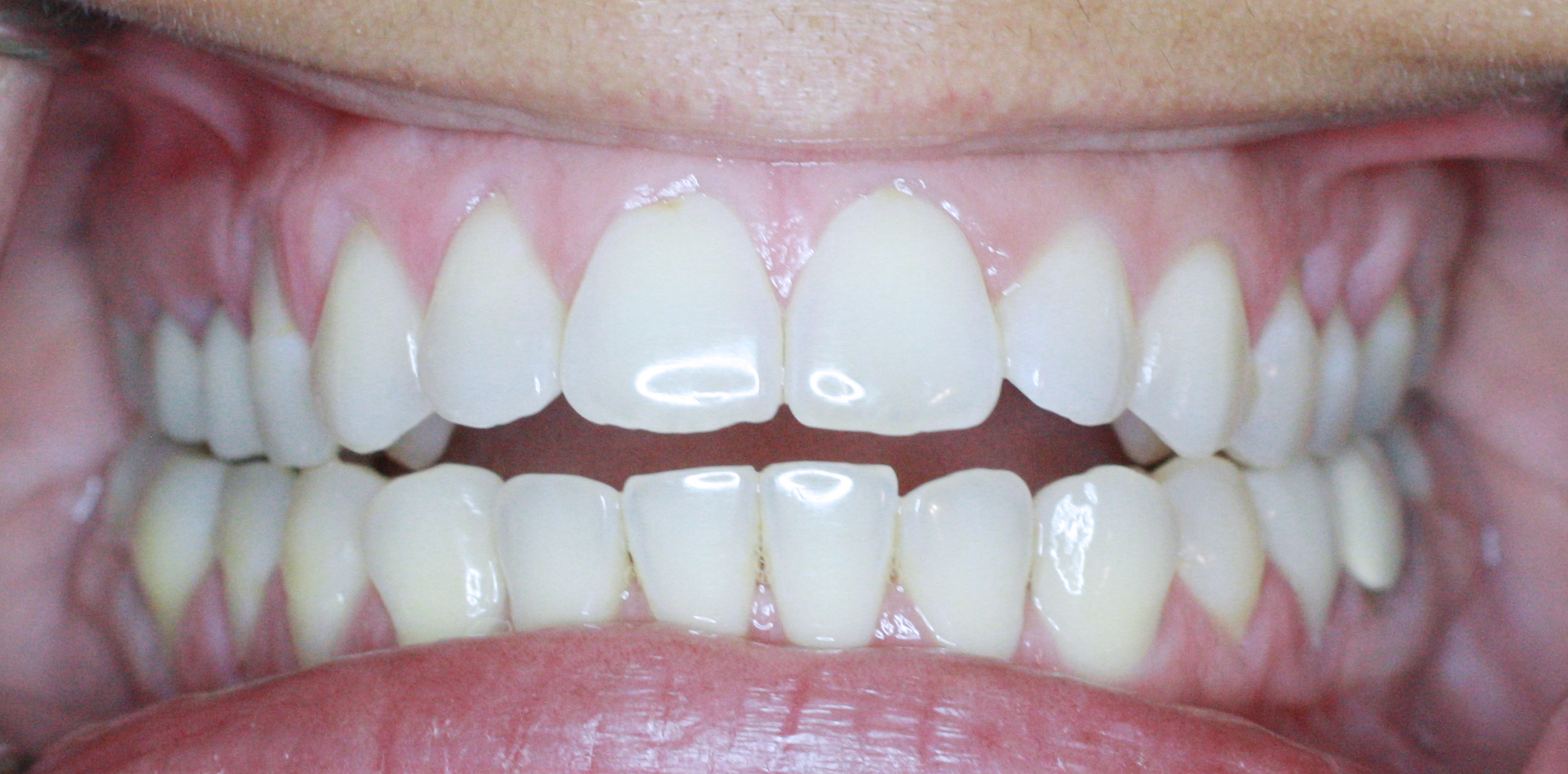 PowerProx 6-month Braces Case 7 Before