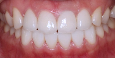 Veneer Case 3 after