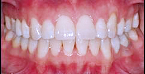 Invisalign Case 2 after