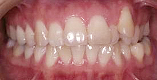 Invisalign Case 2 Before