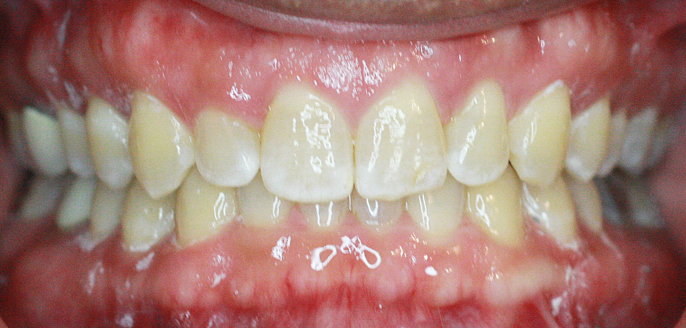 Invisalign Case 3 after