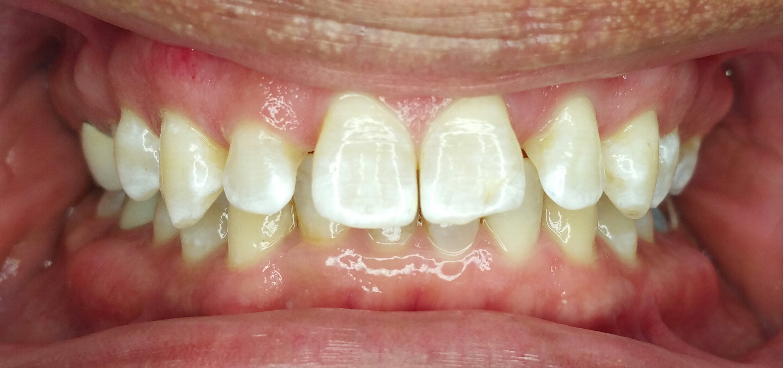 Invisalign Case 3 Before