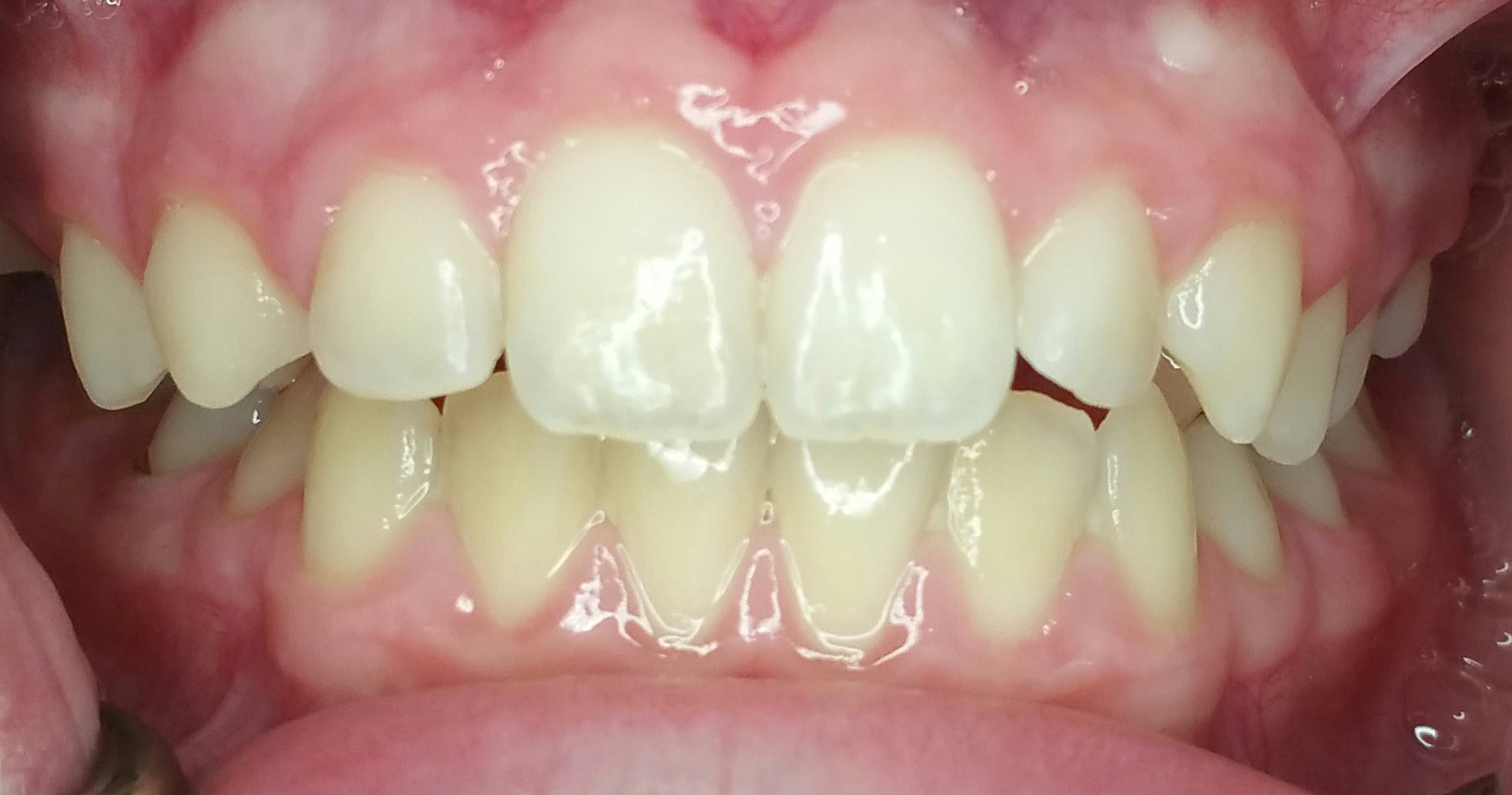 Invisalign Case 4 Before