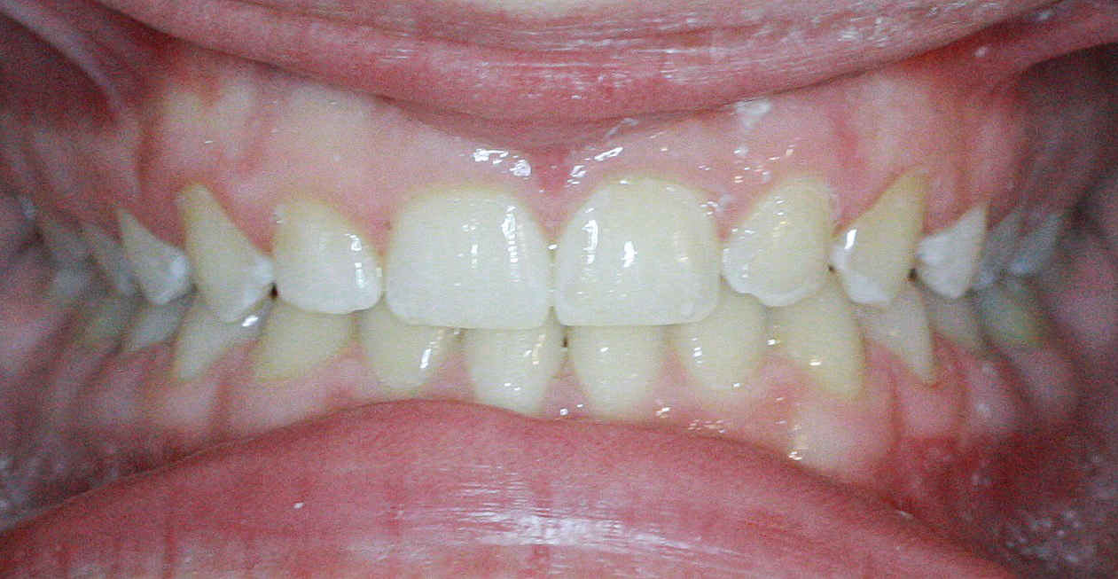 Invisalign Case 5 after
