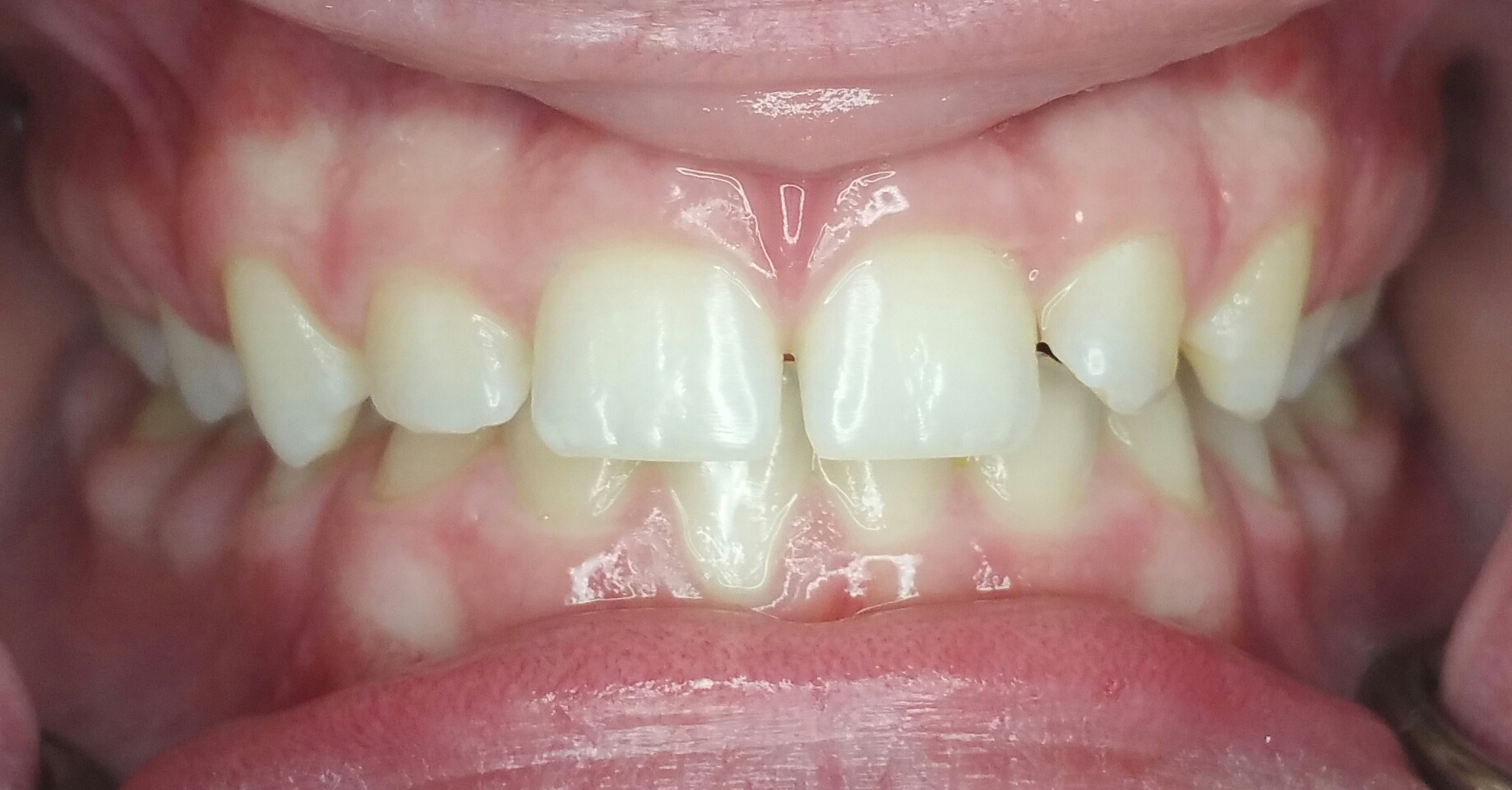 Invisalign Case 5 Before