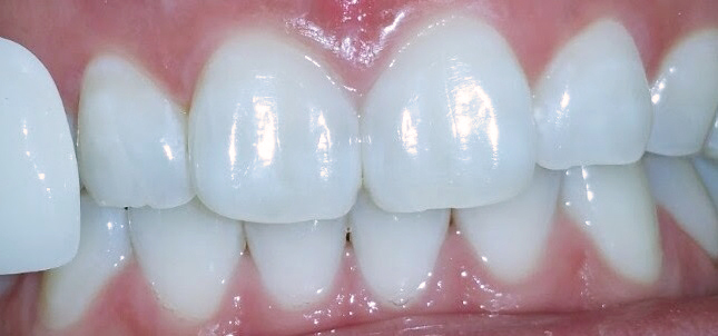 Whitening Case 1 after