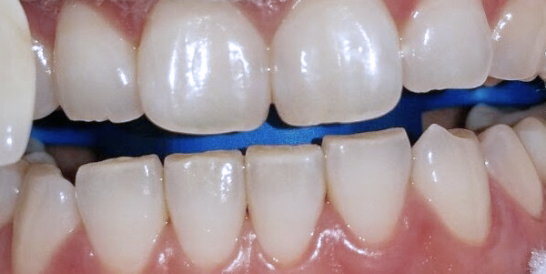 Whitening Case 1 Before