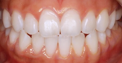 Whitening Case 3 after