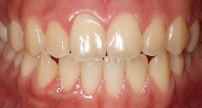 Whitening Case 3 Before