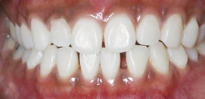 Whitening Case 4 after