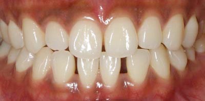 Whitening Case 4 Before